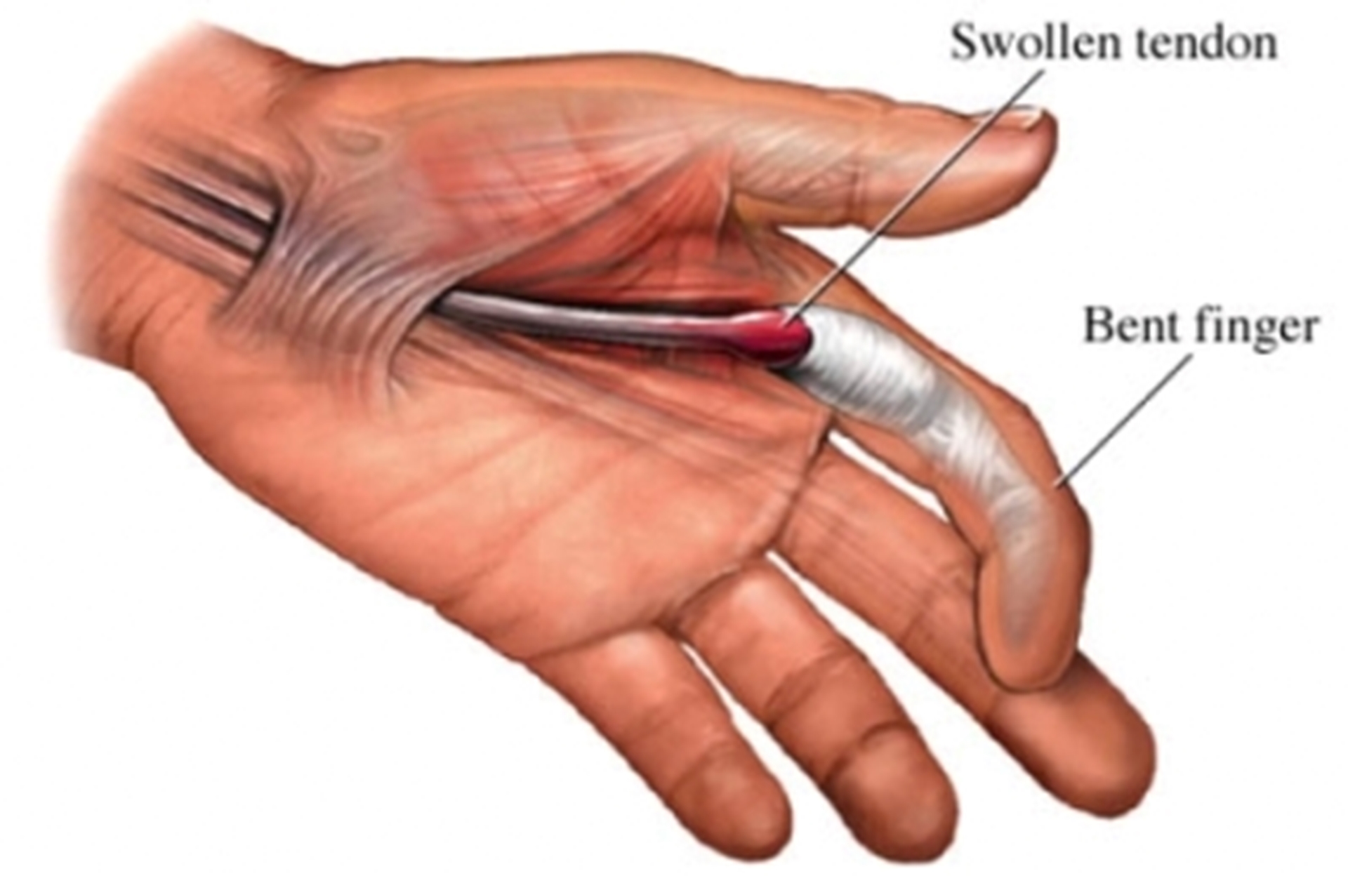 trigger-finger-main